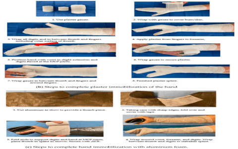 Effective Splinting Techniques for AC Joint Injuries: A Comprehensive Guide